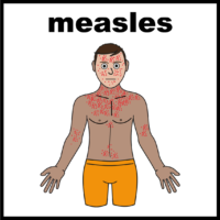 measles