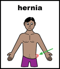 hernia