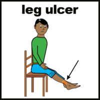 leg ulcer