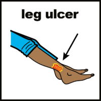 leg ulcer V3