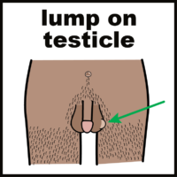 lump on testicle