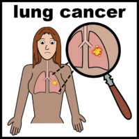 lung cancer V2